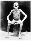 An emaciated Australian POW from a camp in Thailand or Burma, 1945.  A combination of malnutrition, disease, overwork and Japanese brutality caused the deaths of nearly 2,650 Australian POWs during the construction of the Burma-Thai railway.  A total of approximately 22,000 Australians were captured by the Japanese in the first months of the Pacific War and 8,031 of them died in captivity.  Australian public opinion was outraged at the barbaric treatment of POWs by the Japanese.